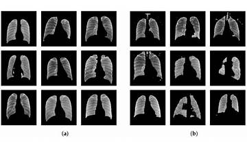 AI, Vol. 3, Pages 931-947: A Patient-Specific Algorithm for Lung Segmentation in Chest Radiographs